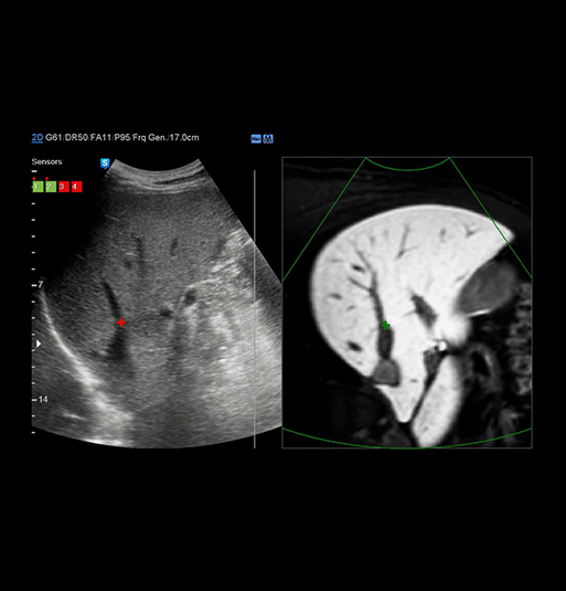 S-Detect™ for Breast
