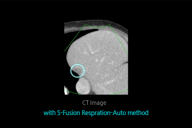 S-Detect™ for Thyroid