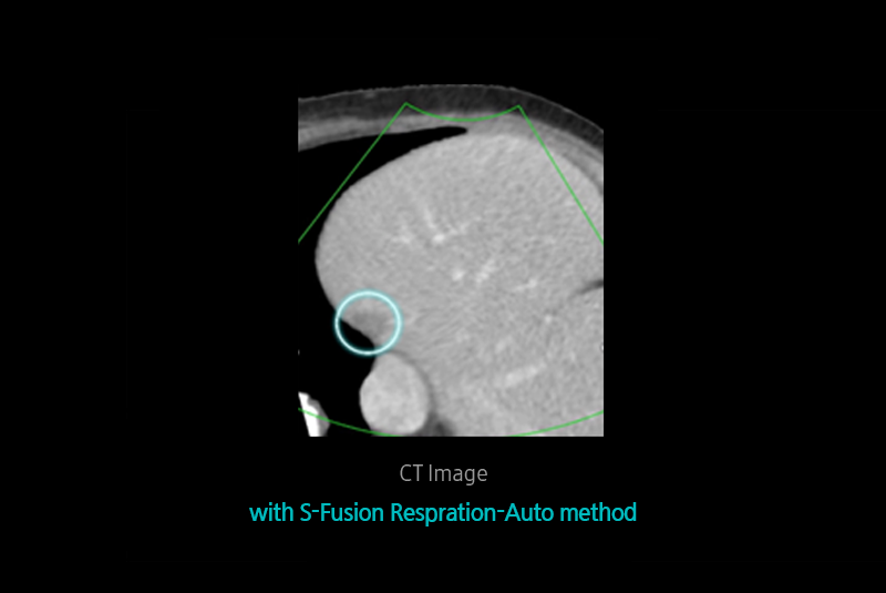 S-Detect™ for Thyroid