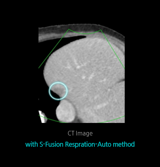 S-Detect™ for Thyroid