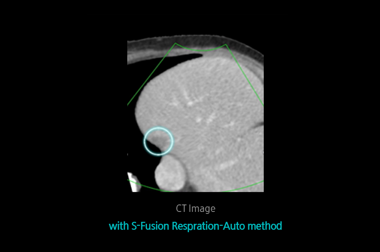 S-Detect™ for Thyroid