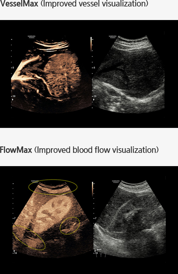 VesselMax (Improved vessel visualization)