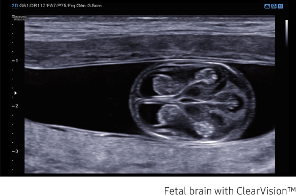 Fetal brain with ClearVision™
