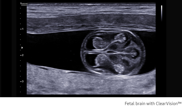 Fetal brain with ClearVision™