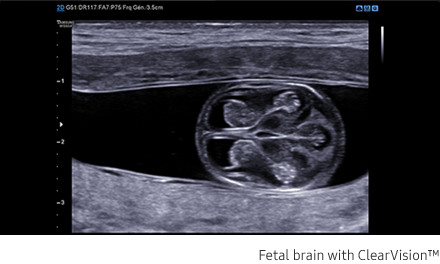 Fetal brain with ClearVision™