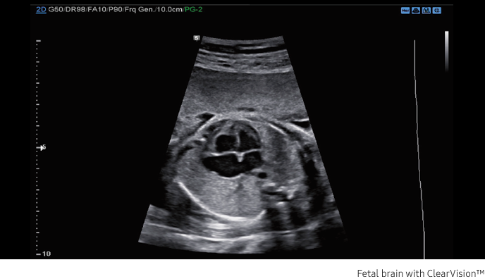Fetal brain with ClearVision™