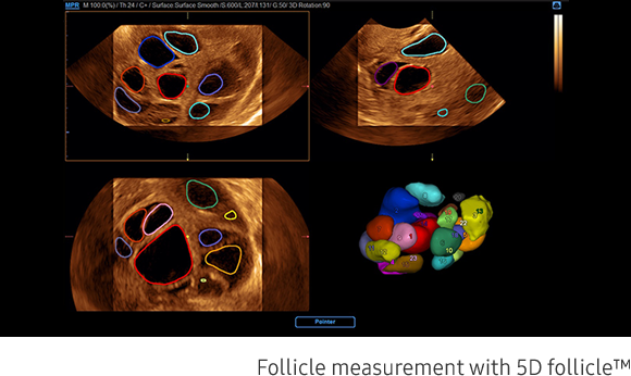 Follicle measurement with 5D follicle™