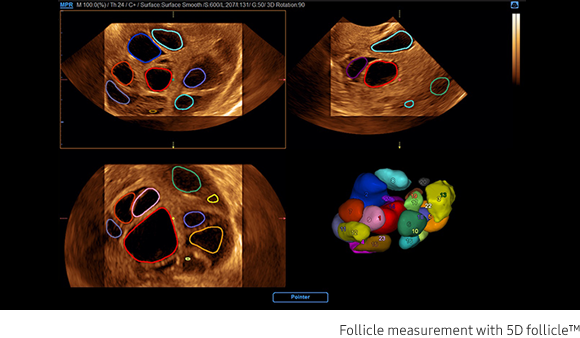 Follicle measurement with 5D follicle™
