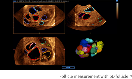 Follicle measurement with 5D follicle™