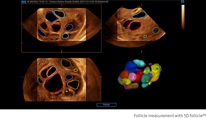 Follicle measurement with 5D follicle™