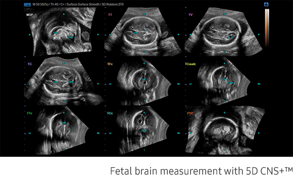 Fetal brain measurement with 5D CNS+™