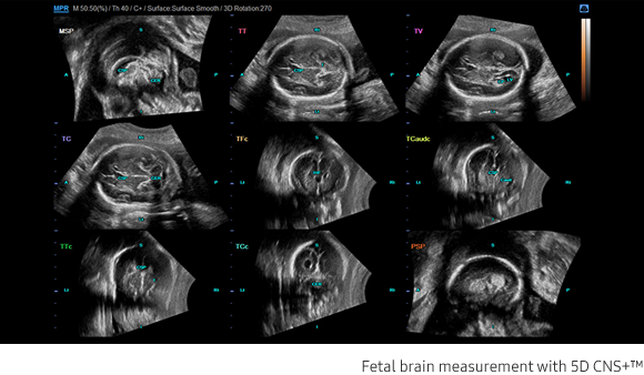 Fetal brain measurement with 5D CNS+™