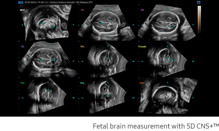 Fetal brain measurement with 5D CNS+™
