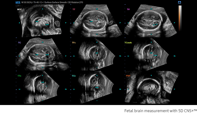 Fetal brain measurement with 5D CNS+™