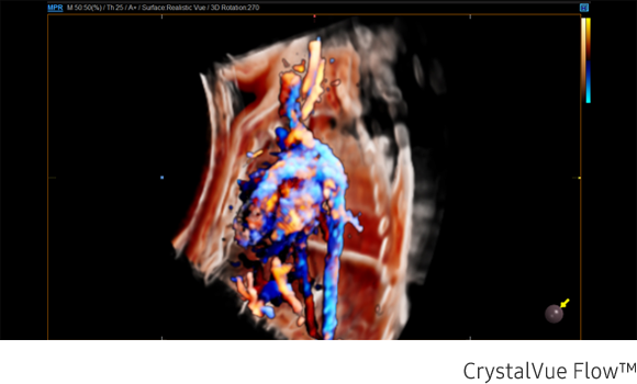 Fetal circulation in Crystal Vue Flow™