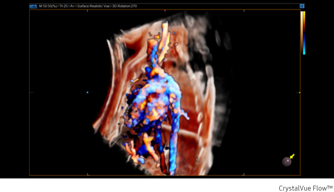 Fetal circulation in Crystal Vue Flow™