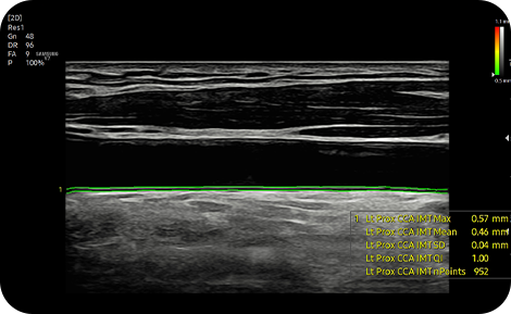 cardiovascular ultrasound tech : AutoIMT+