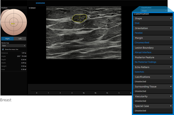 S-Detec for Breast