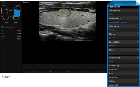 S-Detect for Thyroid