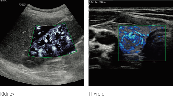 MV-FlowTM_Kidney, MV-FlowTM_Thyroid