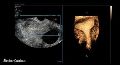 Contorno uterino