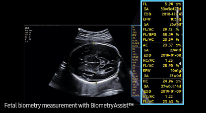 Medición de la biometría fetal con BiometryAssist™