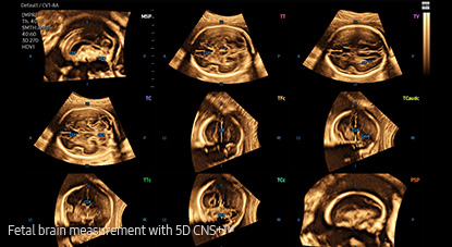 Medición del cerebro fetal con 5D CNS+™