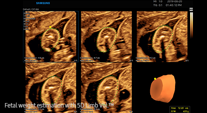 Estimación del peso fetal con 5D Limb Vol.™