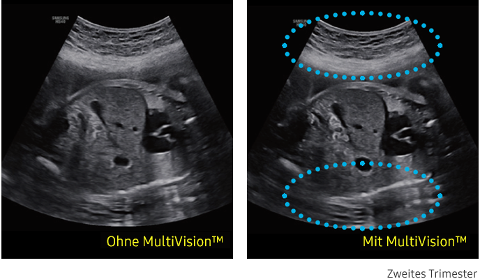 Ultraschallbild links ohne MultiVision, rechts mit MultiVision