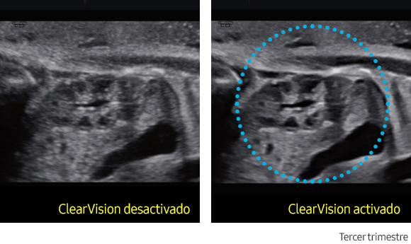 ClearVision™ Sample