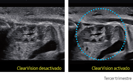 ClearVision™ Sample