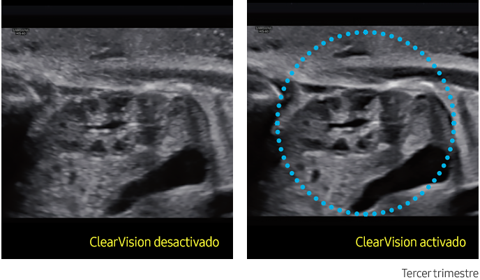 ClearVision™ Sample