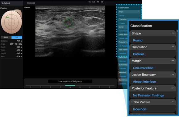 S-Detect™ for Breast