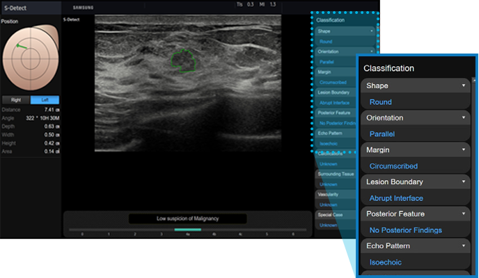 S-Detect™ for Breast