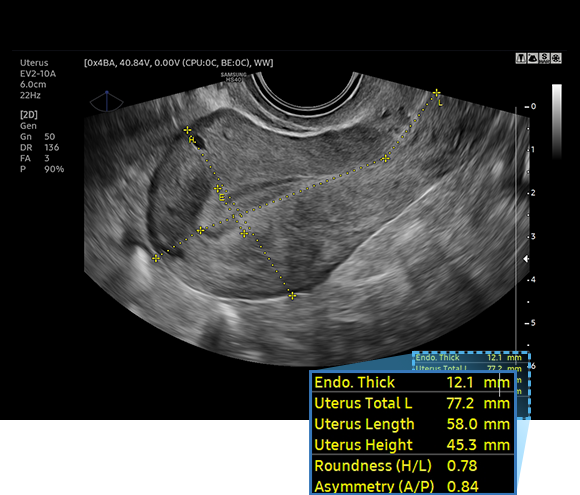 UterineAssist