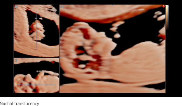 Nuchal translucency