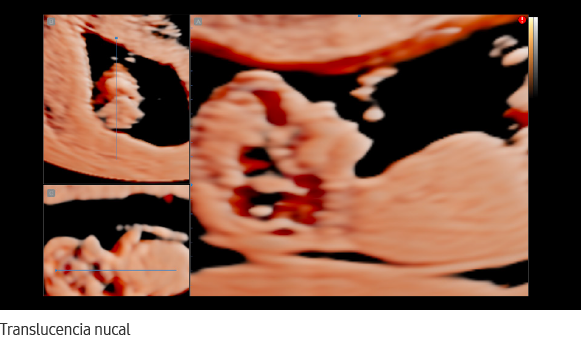 Translucencia nucal