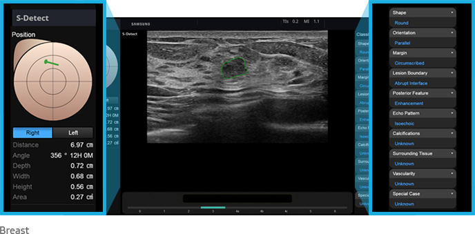 S-Detect™ for Breast