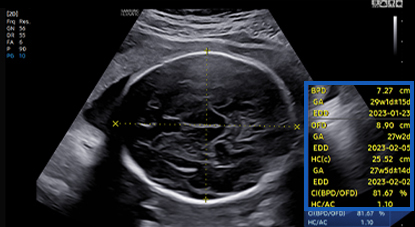 medical diagnostics : BiometryAssist™