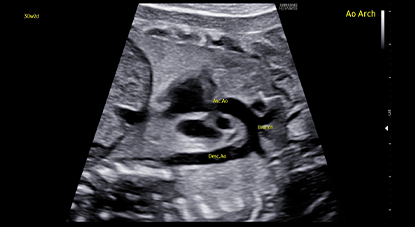 ob ultrasound tech : ViewAssist™