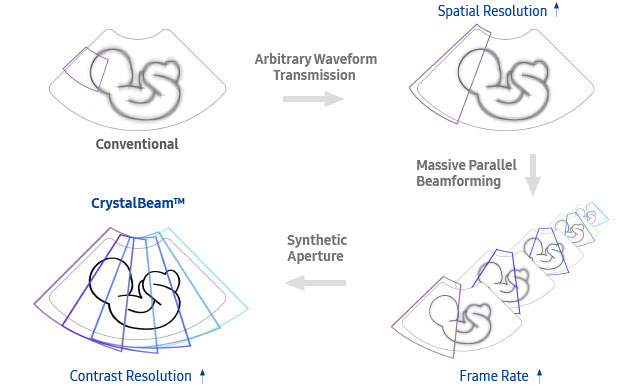 fetal images : Conventional - Better Spatial Resolution - Higher Frame Rate - More detailed and faster beam process