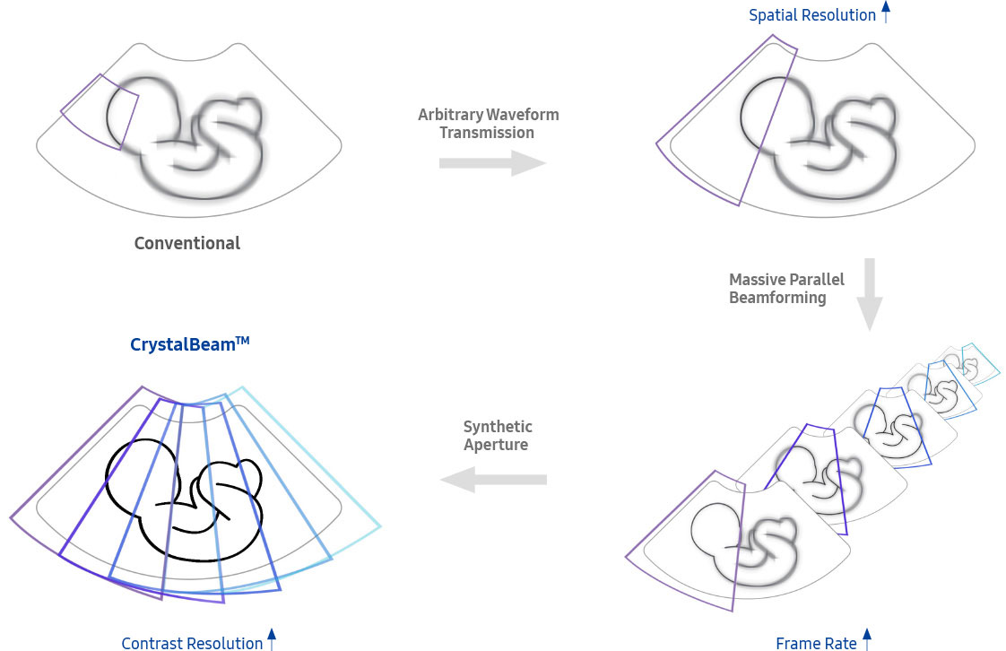 fetal images : Conventional - Better Spatial Resolution - Higher Frame Rate - More detailed and faster beam process