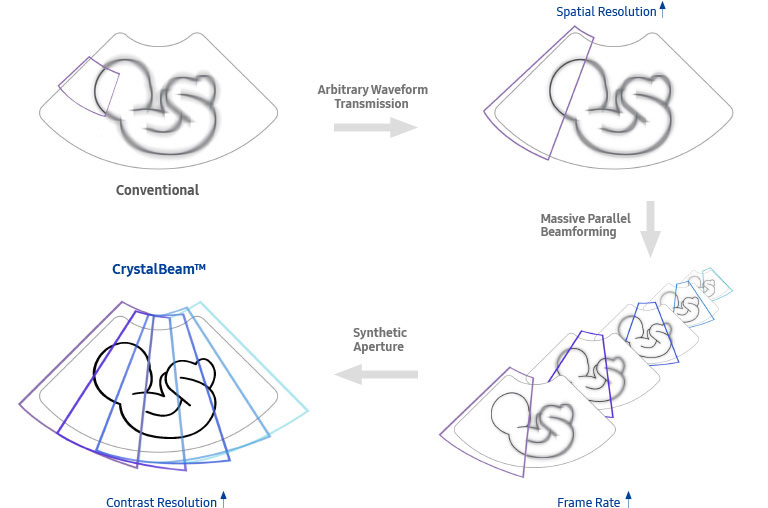 fetal images : Conventional - Better Spatial Resolution - Higher Frame Rate - More detailed and faster beam process