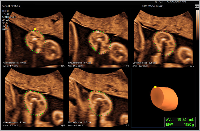 5d ultrasound : 5D Limb Vol.™