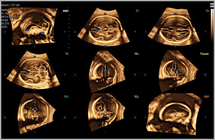 5d ultrasound : 5D CNS+™