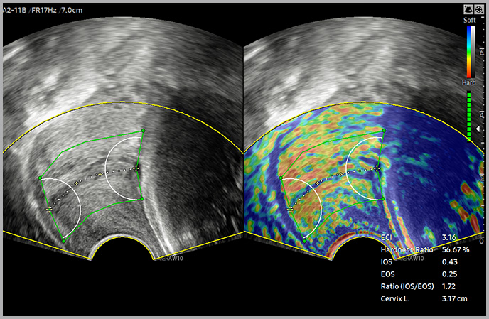 medical diagnostics : E-Cervix™ ¹