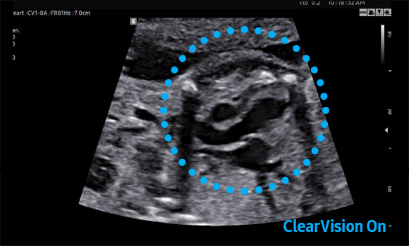 powerful imaging : ClearVision - on