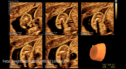 5d ultrasound : 5D Limb Vol.™