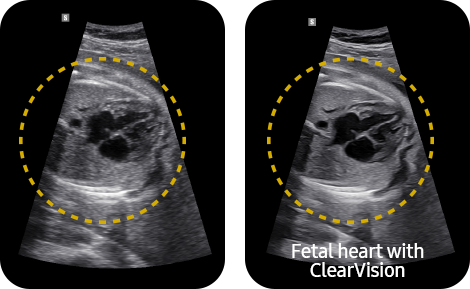 Kidney with ClearVision