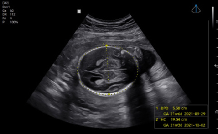 medical diagnostics : BiometryAssist™